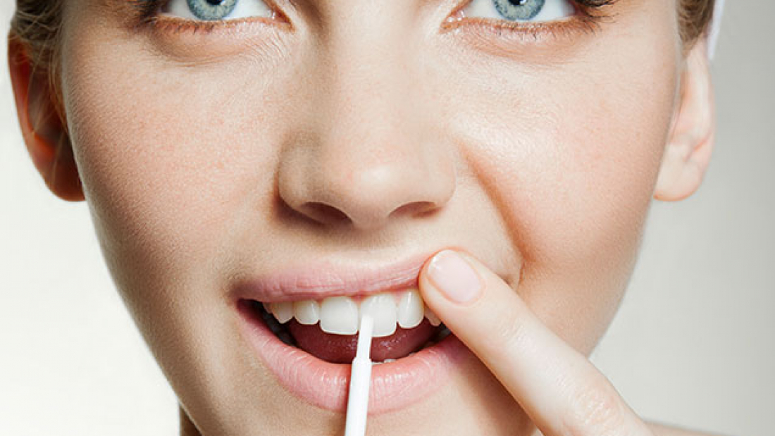 toothbleeching_aligner1